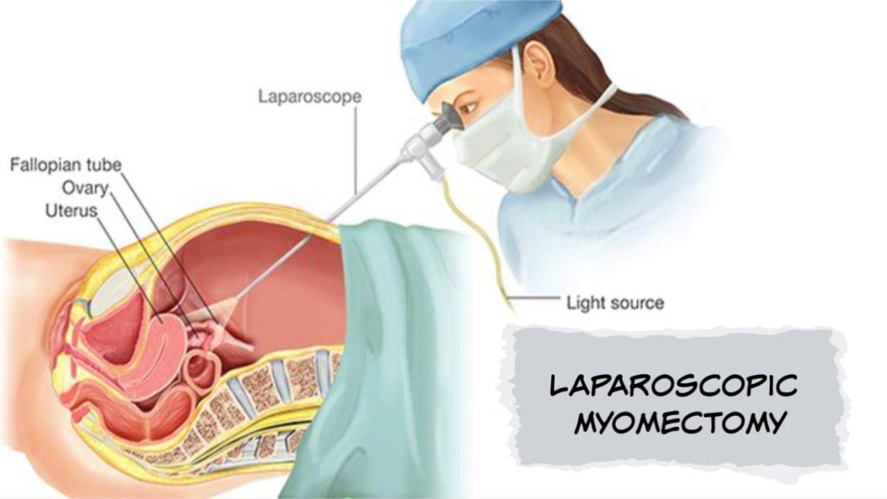 Myomectomy